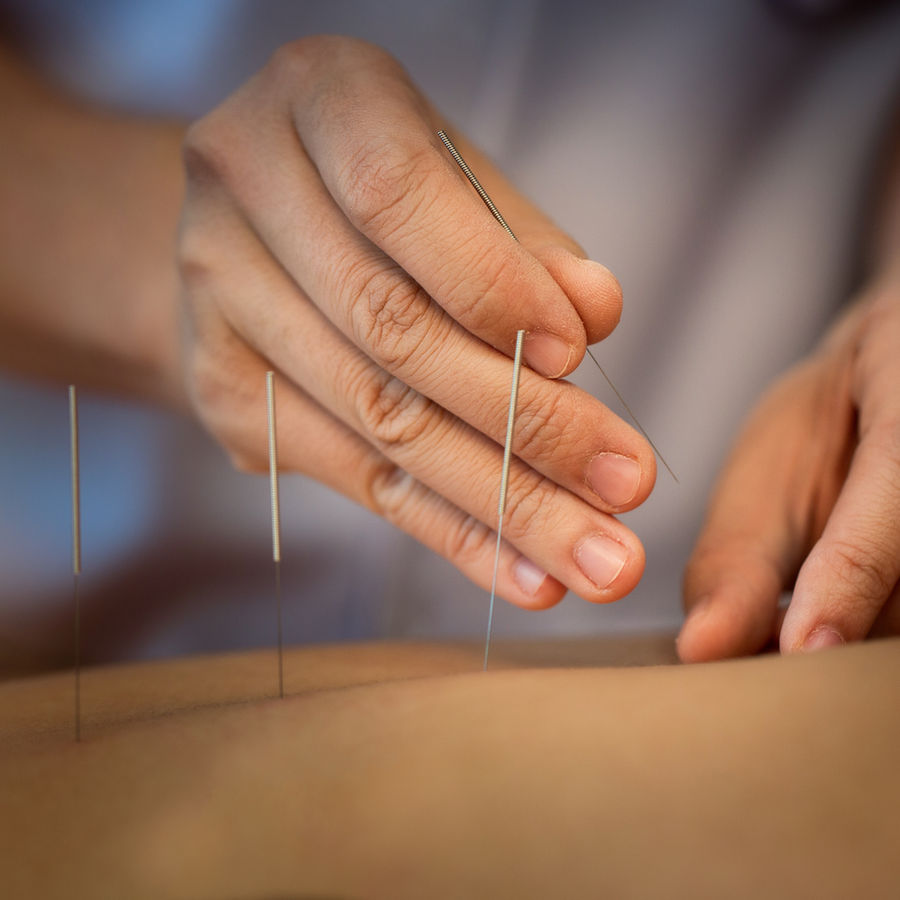 Acupuncture